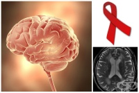 B22.0 Болест, предизвикана от HIV, с прояви на енцефалопатия