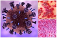 B21.0 Болест, предизвикана от HIV, с прояви на Kaposi-сарком