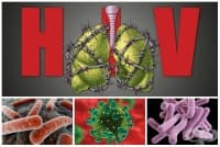B20.0 Болест, предизвикана от HIV, с прояви на микобактериална инфекция