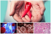 B20.6 Болест, предизвикана от HIV, с прояви на пневмония, предизвикана от Pneumocystis carinii