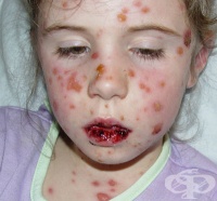 L51.1 Булозна erythema multiforme
