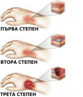 X77 Умишлено самонараняване от пари, горещи изпарения и горещи предмети