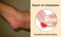 M70.2 Бурсит на олекранона