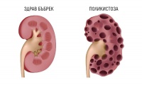 Q61.2 Бъбречна поликистоза, адулторен тип