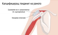 M75.3 Калцифициращ тендинит на рамото