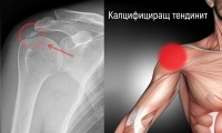 M65.2 Калцифициращ тендинит