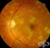 H32.0 Хориоретинално възпаление при инфекциозни и паразитни болести, класифицирани другаде