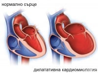 I42.0 Дилатативна кардиомиопатия