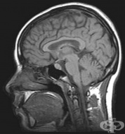 G93.2 Доброкачествена вътречерепна хипертензия