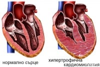 I42.2 Друга хипертрофична кардиомиопатия