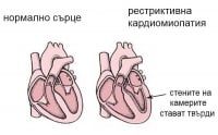 I42.5 Друга рестриктивна кардиомиопатия