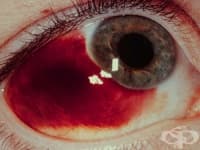 H44.8 Други болести на очната ябълка