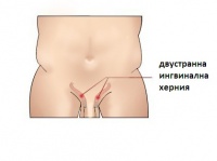 K40.0 Двустранна ингвинална херния с непроходимост без гангрена