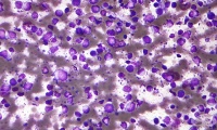 C83.3 Едроклетъчен (дифузен)