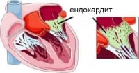 I38 Ендокардит без уточняване на засегнатата клапа