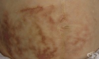 L59.0    [dermatitis ab igne]
