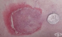 L53.1 Erythema annulare centrifugum