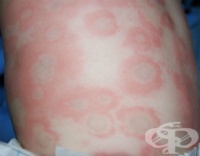 L51.9 Erythema multiforme, неуточнена