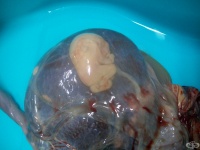 O31.0 Fetus papyraceus