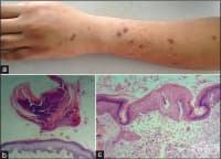 L87.0    ,    [  Kyrle]