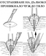 W45 Проникване на чуждо тяло през кожата