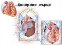 T86.2 Отмиране и отхвърляне на трансплантат на сърце