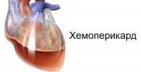 I31.2 Хемоперикард, некласифициран другаде