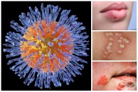 B00 - [herpes simplex] 