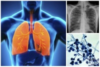 B39.1 Хронична белодробна инфекция, предизвикана от Histoplasma capsulatum