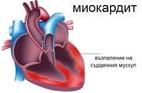 I40.0 Инфекциозен миокардит