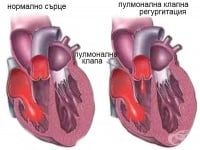 I37.1 Инсуфициенция на пулмоналната клапа