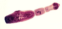 B67.5 Инвазия на черния дроб, предизвикана от Echinococcus multilocularis