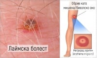 A69.2 Лаймска болест