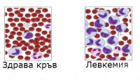 C95 Левкемия с неуточнен клетъчен тип