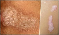 L90.0 Lichen sclerosus et atrophicus