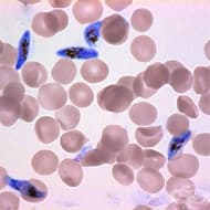 B50 Малария, предизвикана от Plasmodium falciparum
