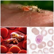 B53.0 Малария, предизвикана от Plasmodium ovale