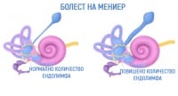 H81.0 Болест на Meniere