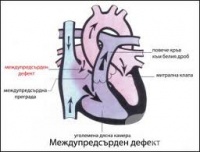 I23.1 Междупредсърден дефект като текущо усложнение на острия инфаркт на миокарда