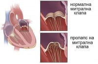 I34.1 Митрален (клапен) пролапс