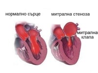 I34.2 Неревматична митрална (клапна) стеноза