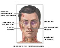S09.7 Множествени травми на главата