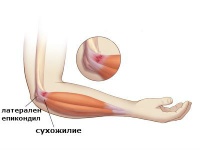 S53.4 Навяхване и разтягане на ставния апарат на лакътната става