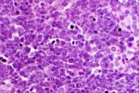 C85.9 Нехочкинов лимфом, неуточнен
