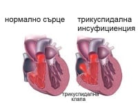 I36.1 Неревматична трикуспидална (клапна) инсуфициенция