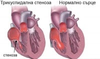 I36.0 Неревматична трикуспидална (клапна) стеноза