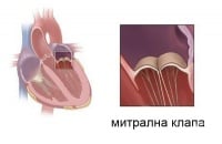 I34 Неревматични болести на митралната клапа