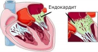 Остър ендокардит, неуточнен Остър ендокардит, неуточнен