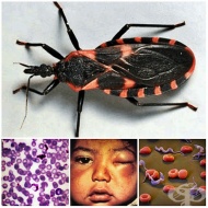 B57.1      Chagas    