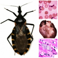 B57.0      Chagas     (I41.2*, I98.1*)